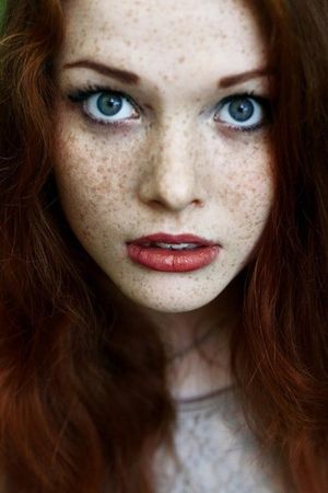 Freckles