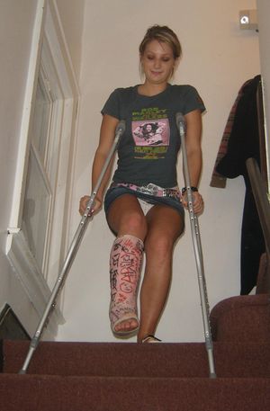 Broken leg upskirt