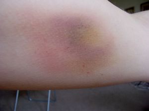Older Bruise
