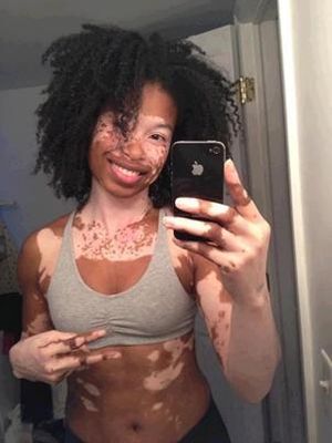 Vitiligo beauty