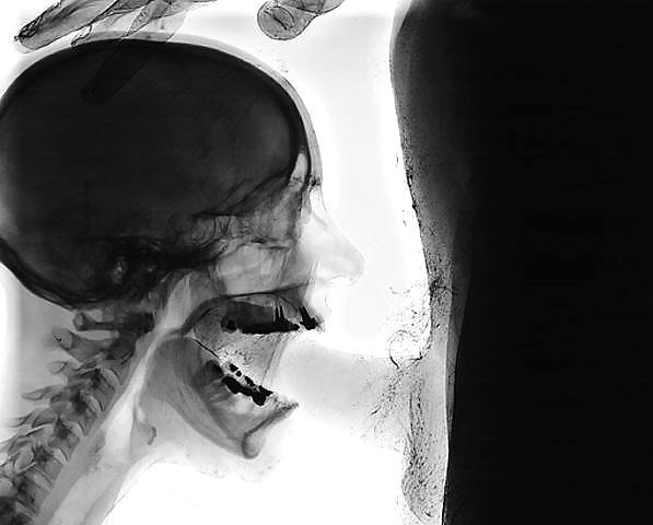 X-ray