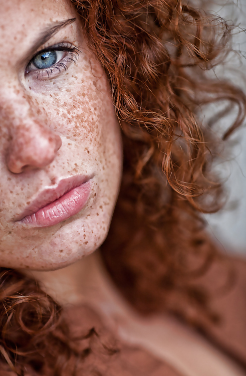freckles :)
