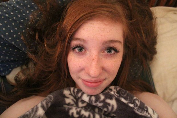 Freckle face