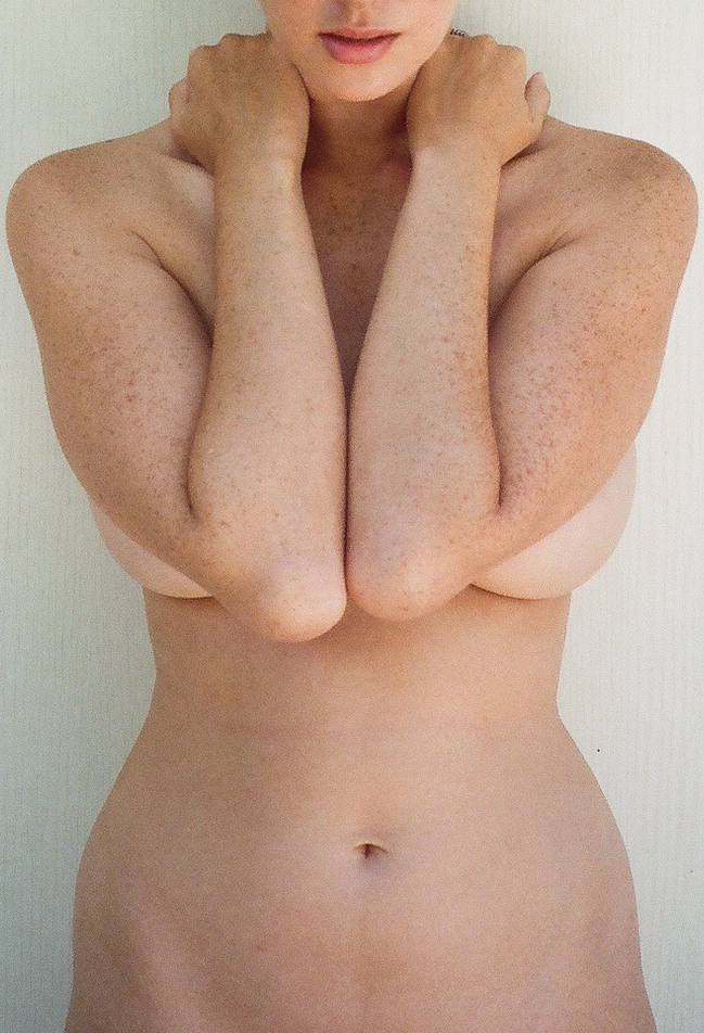freckles