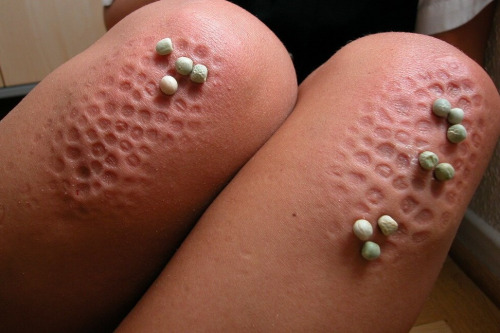 The results from cornertime kneeling on dried peas
