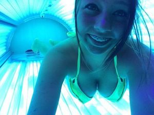 braceface - Getting tanned