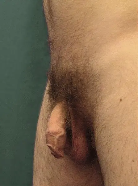 dick erection