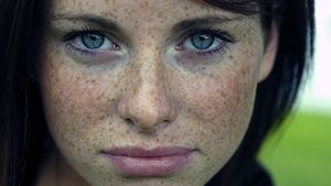 freckles