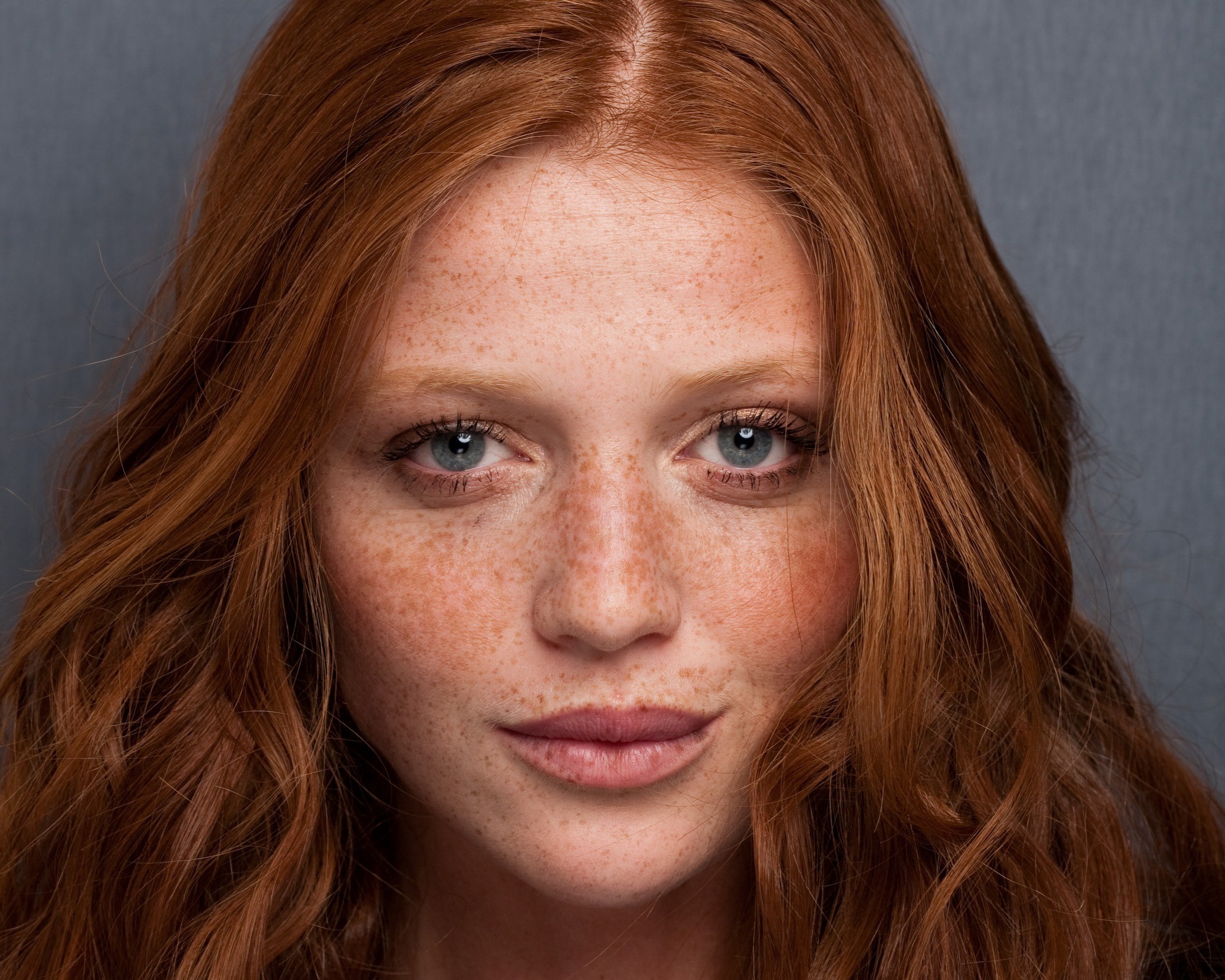freckles