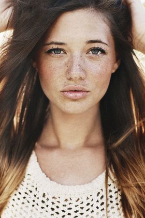 freckles