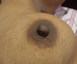 Nipple