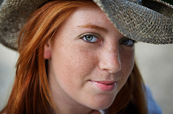 Freckles
