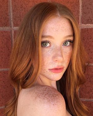 Freckles