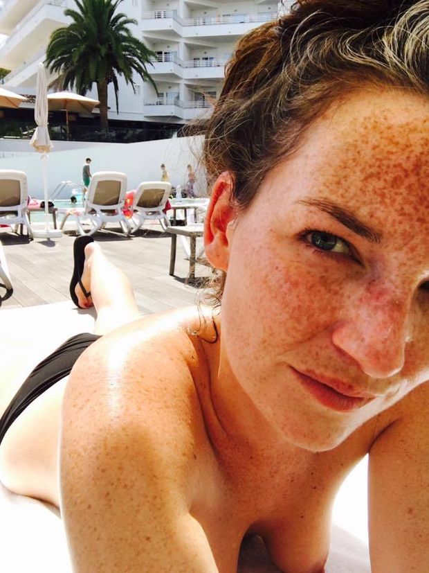 Freckles