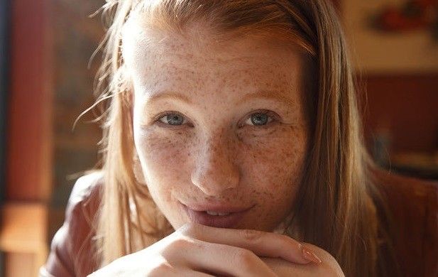 red and freckles