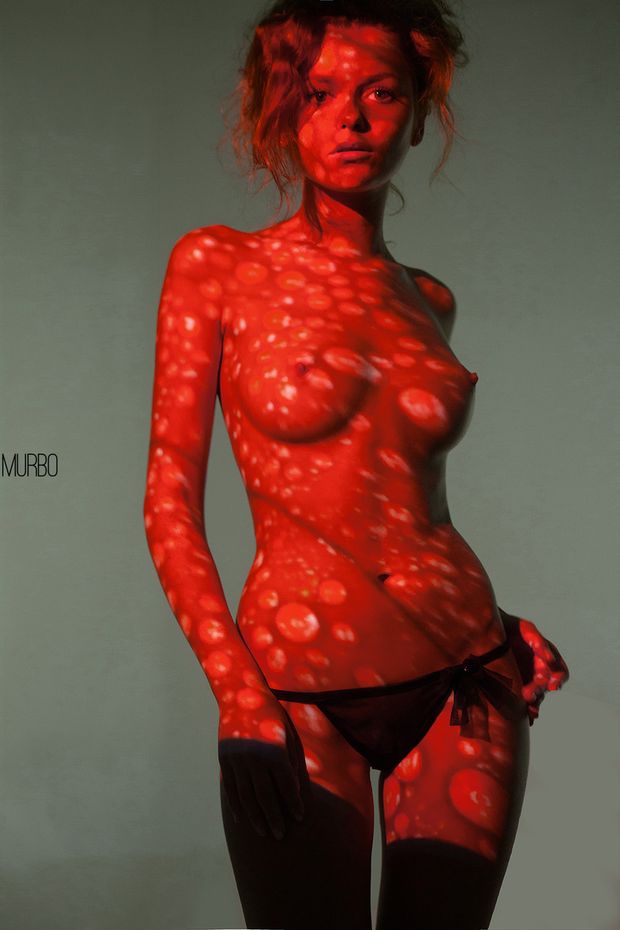 Sunburn