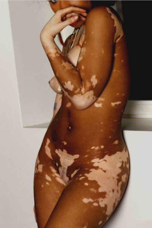 Ebony babe with vitiligo