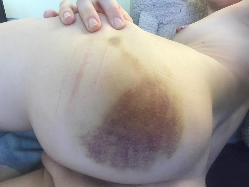 black bruises