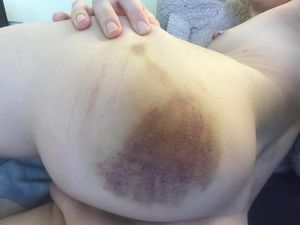 black bruises