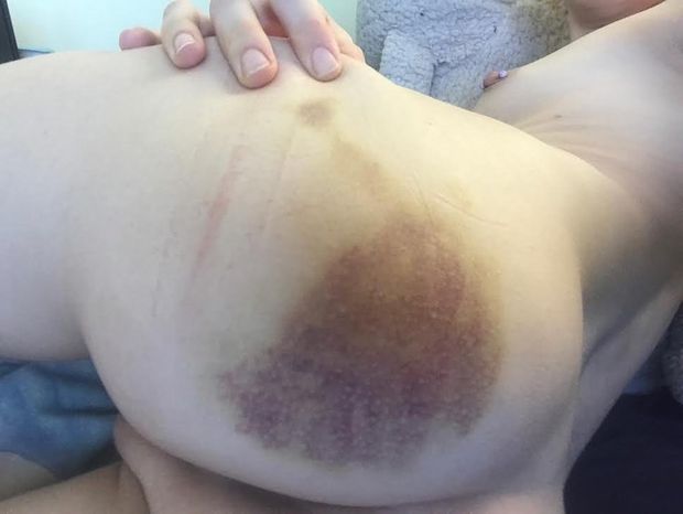 black bruises