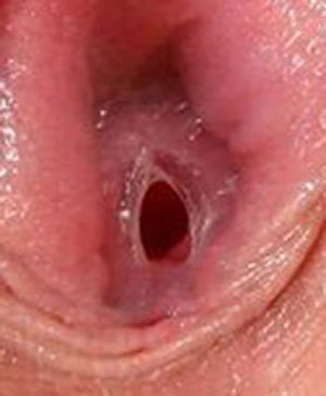 Hymen Closeup Pic