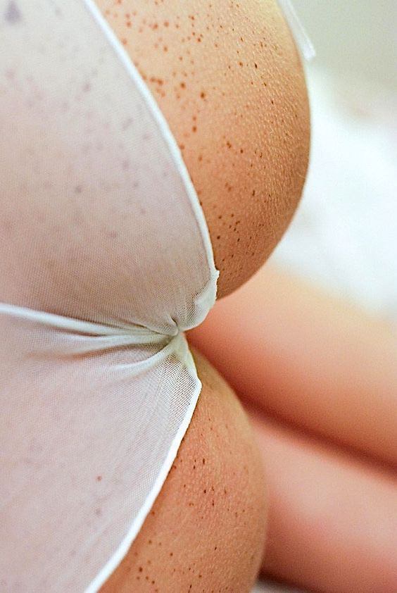 freckles