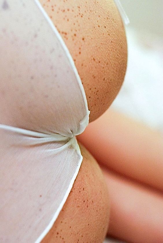 freckles