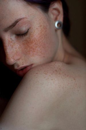 freckles