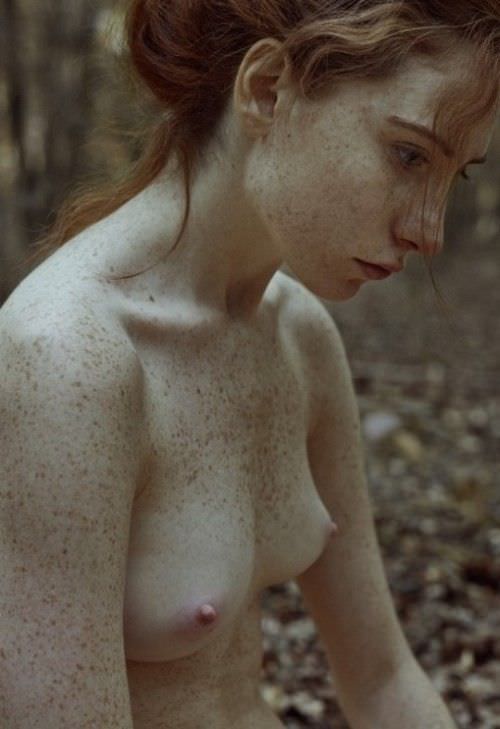 freckles