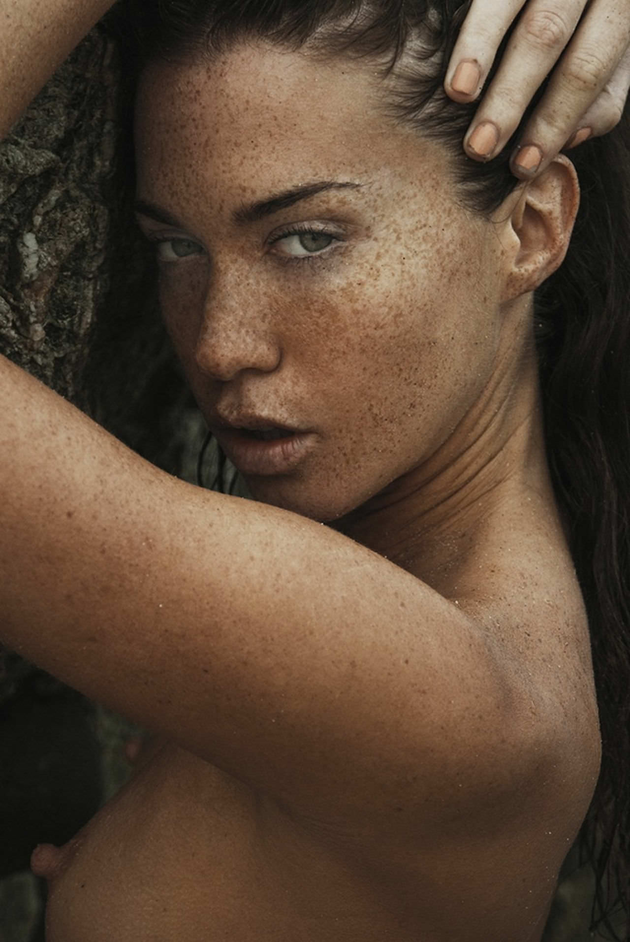 freckles