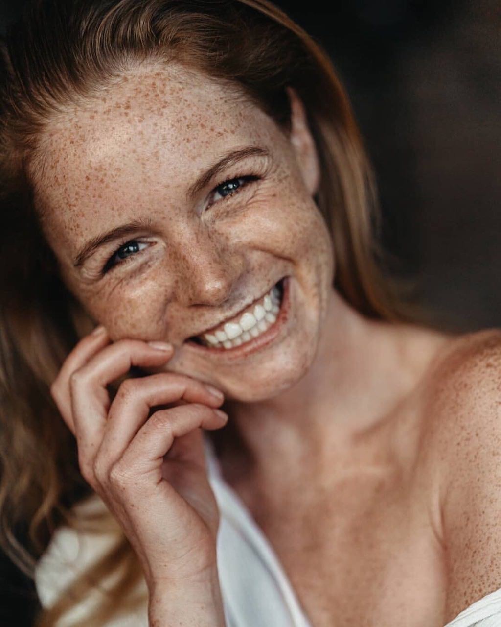 freckles