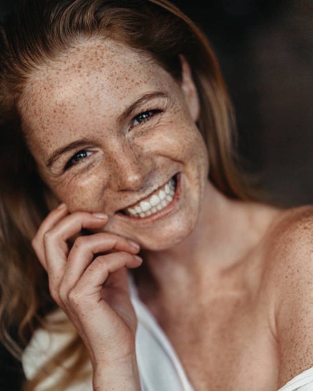 freckles