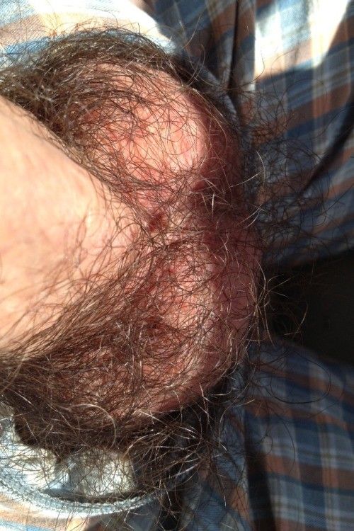Hairy balls..