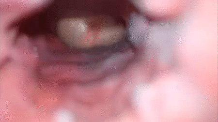 Inside injection