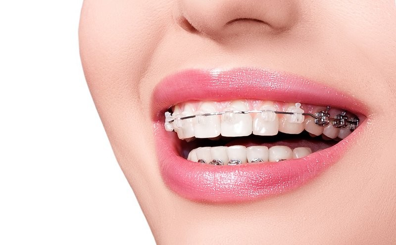 Chia sẻ những kiến thức về niềng răng giúp khắc phục những khuyết điểm của hàm răng như hô, khấp khểnh, ....
