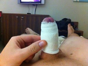 Day 0 - Circumcision