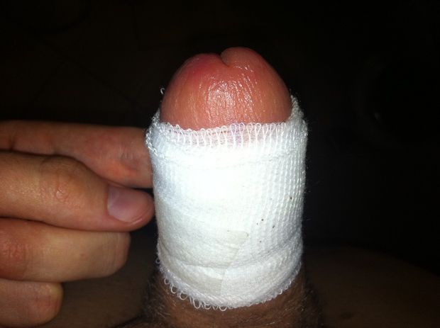 Day 1 - Circumcised