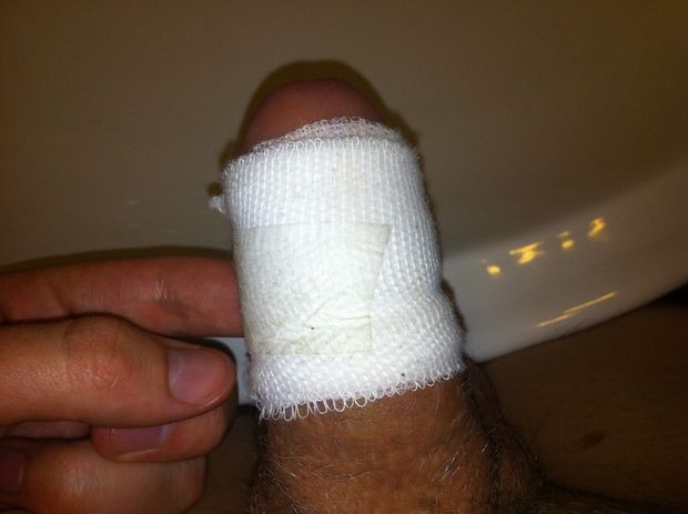 Day 2 - Circumcised