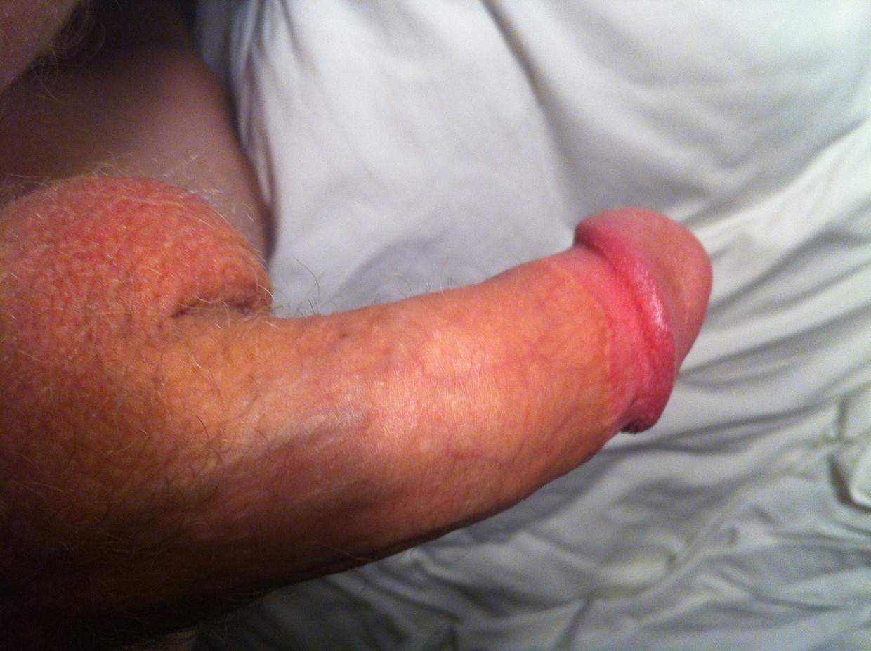 Day 365 soft - Circumcised