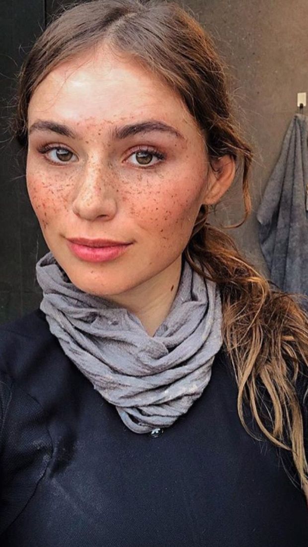 freckles