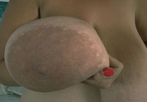 the other huge areola.