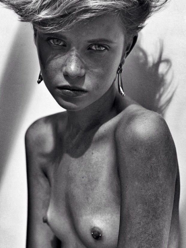 freckles