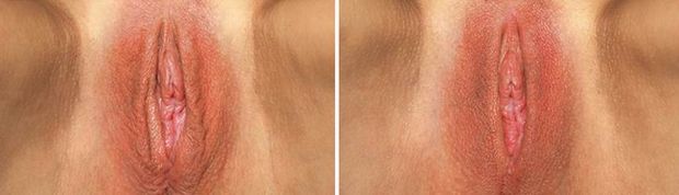 Vaginoplasty - great career!