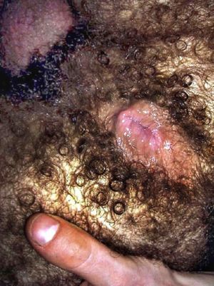 hairy hole