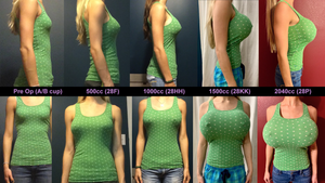 User "TheBiggerTheBetter" from RealSelf shows off her journey from 0 to 2000cc fake tits