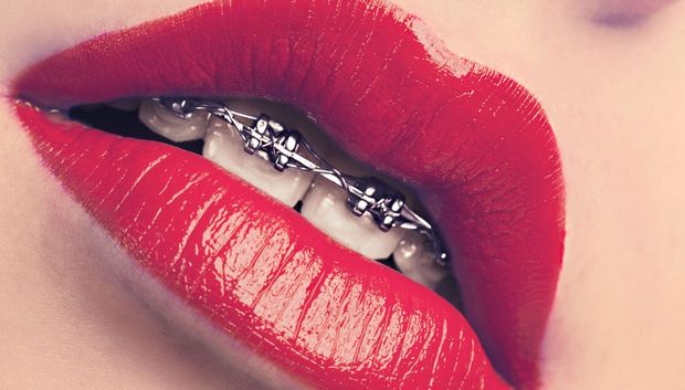 Sexy Mouth With Braces