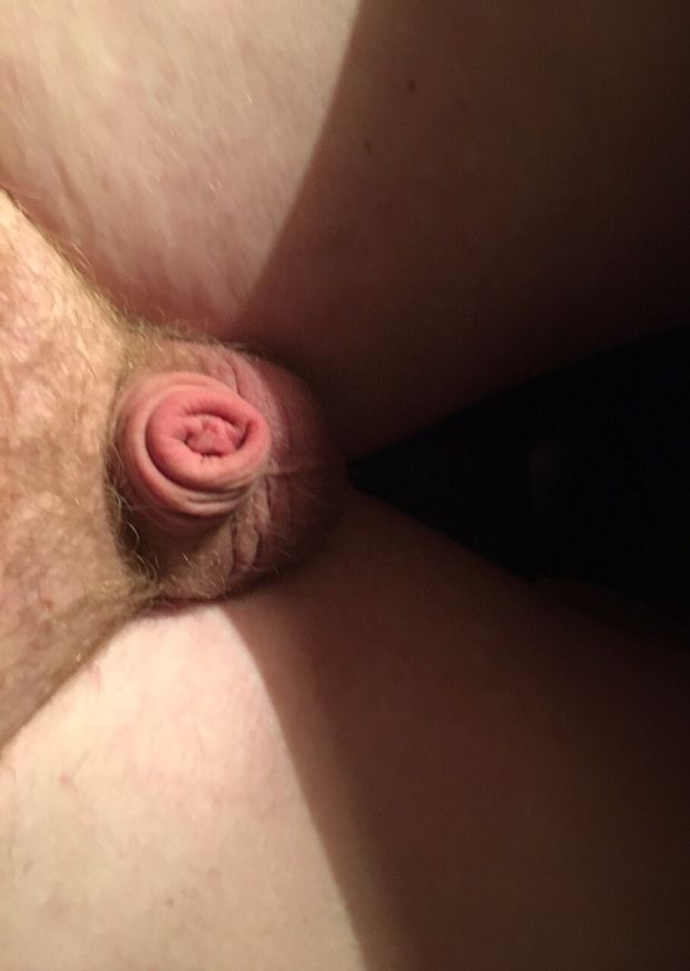 Artem's micropenis
