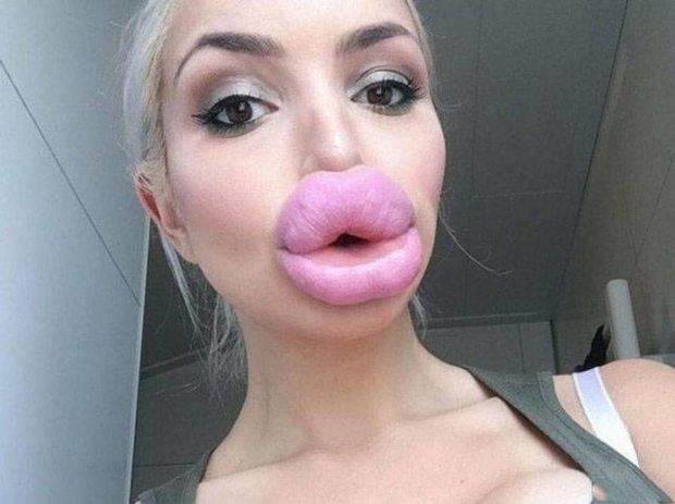i want such fat lip fillers that you can hear me breathing through my permanent gape across the room