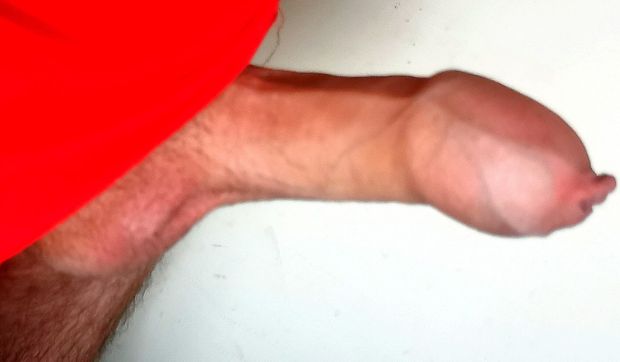 Hard foreskin on