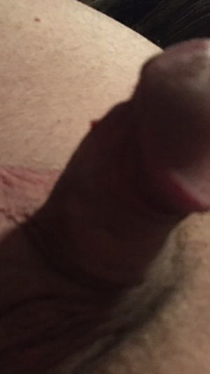 Cuckolds tiny cock with ugly skin tag